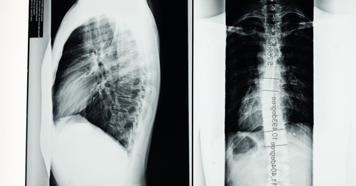 découvrez des informations complètes sur la scoliose, y compris ses causes, ses symptômes, son diagnostic et ses options de traitement. découvrez des conseils pour gérer la scoliose et améliorer votre qualité de vie.