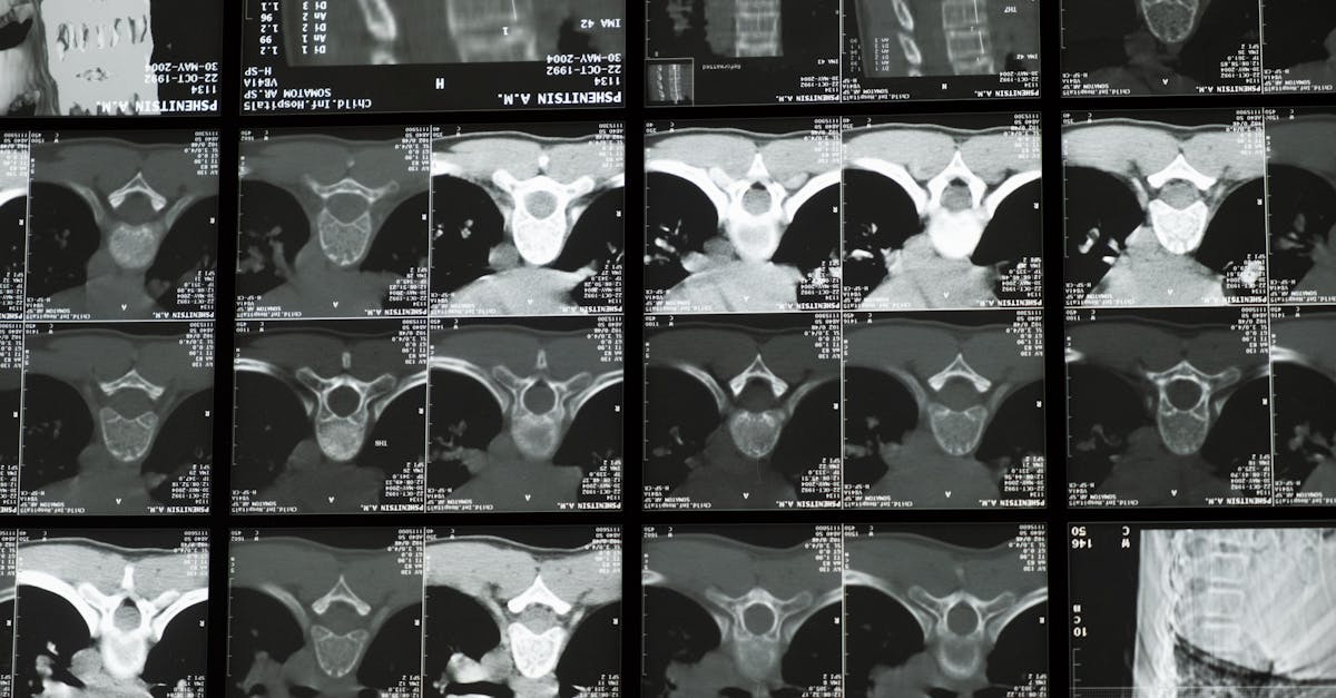 discover comprehensive insights on scoliosis, including its causes, symptoms, diagnosis, and treatment options. learn how to manage this spinal condition effectively and improve quality of life.