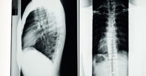 discover essential information about scoliosis, including its causes, symptoms, and treatment options. learn how to manage this condition effectively and improve your quality of life.